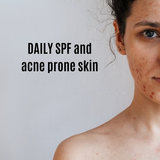 SPF and Acne Prone Skin