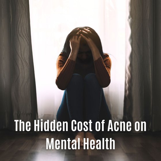 The Hidden Cost of Acne on Mental Health