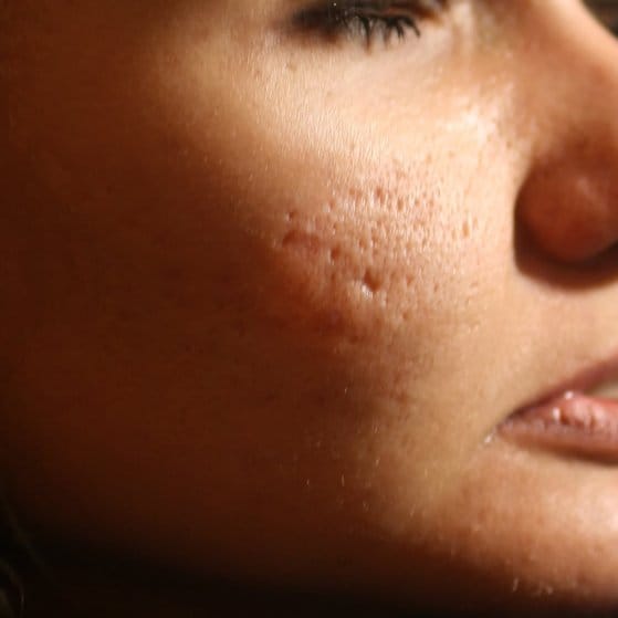 acne-scarring