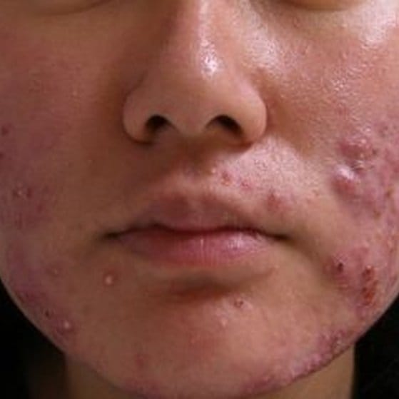 adult-acne