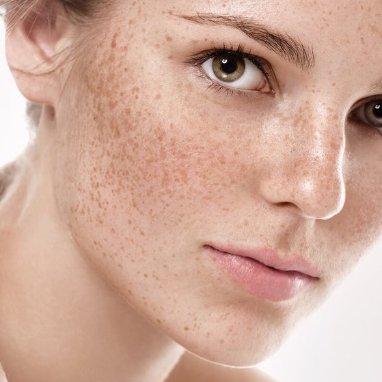 freckles