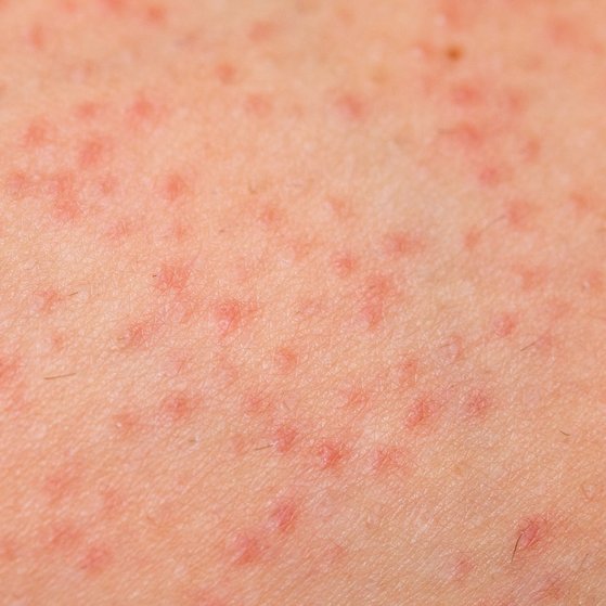 gram-negative-folliculitis