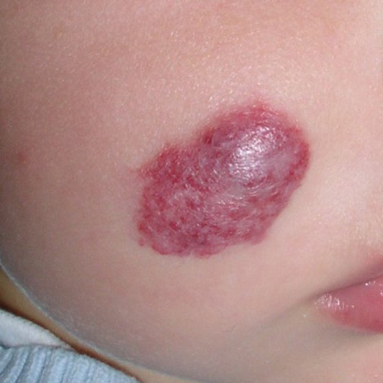 hemangioma
