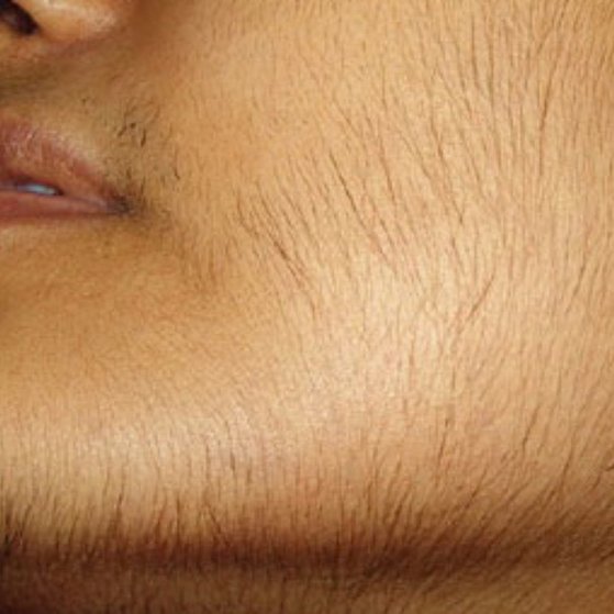 hirsutism