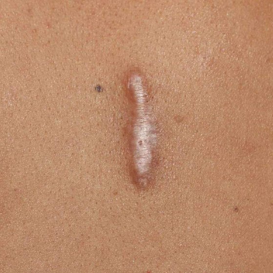 keloid-scar