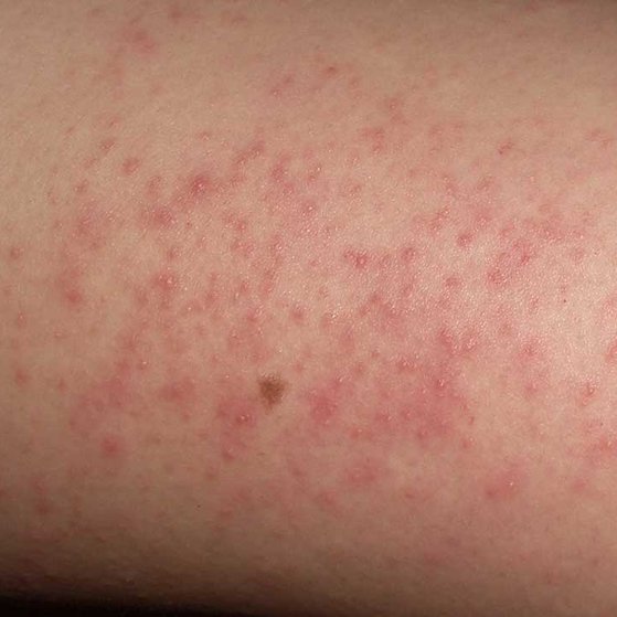 keratosis-pilaris