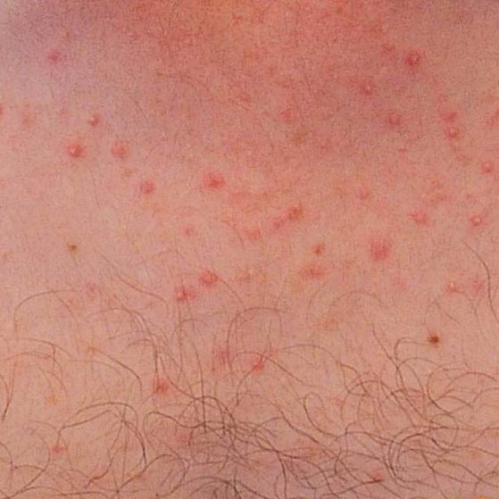 pityrosporum-folliculitis