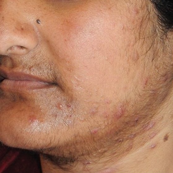 polycystic ovary syndrome