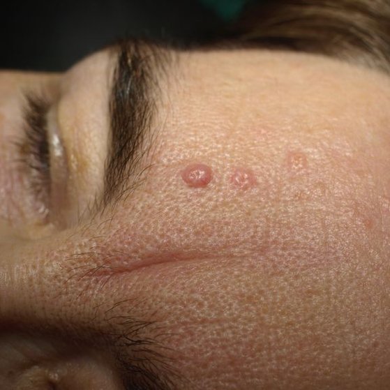 sebaceous-hyperplasia