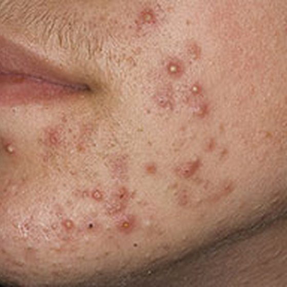 staphylococci-folliculitis