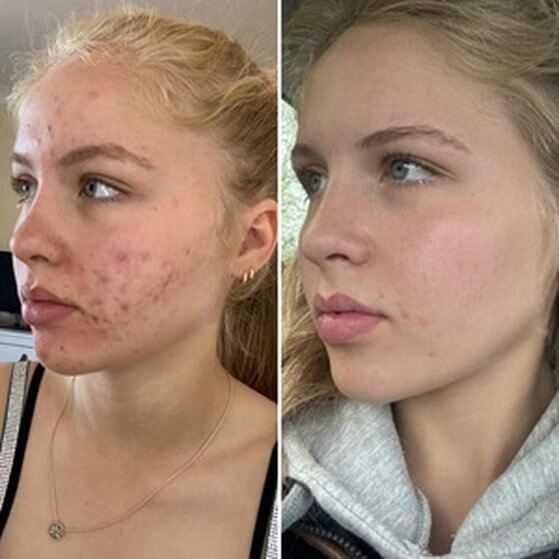 acne bootcamp treatment