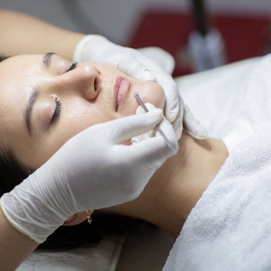 acne extractions treatment