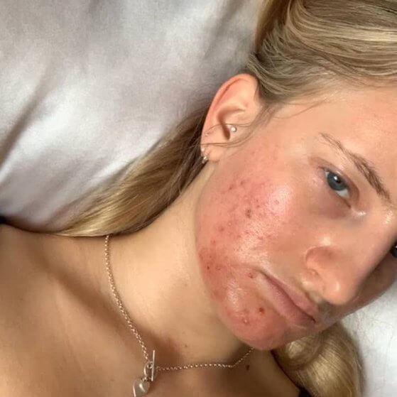 acne facial treatment feature