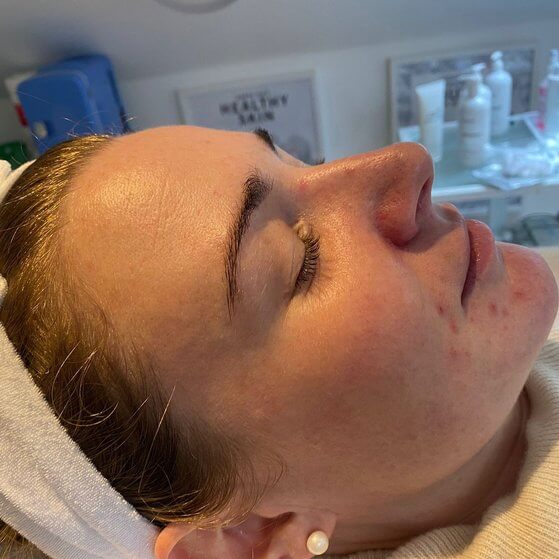 acne maintenance treatment