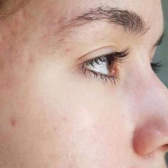 after acne facial treatment