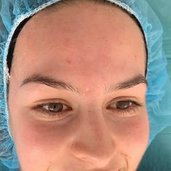 after acne scarring treatment