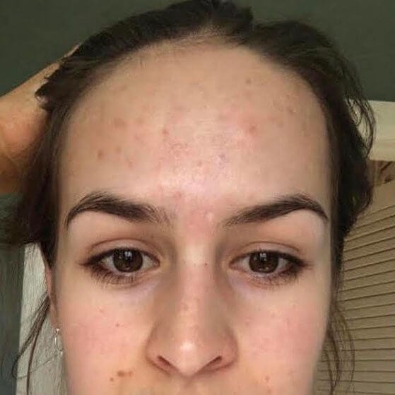 before acne scarring treatment