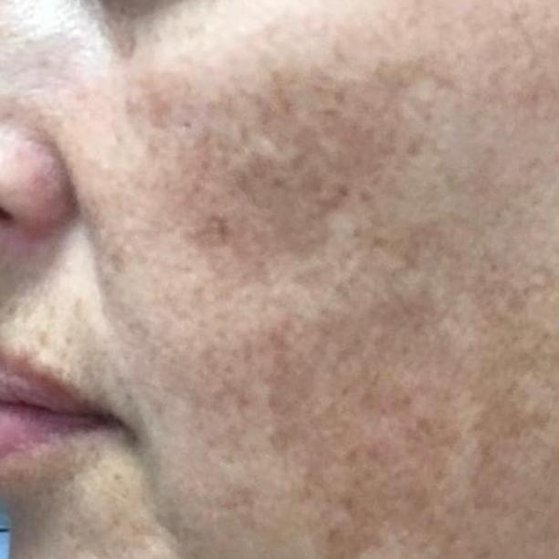 Cosmelan 1 before crop ynrc3el