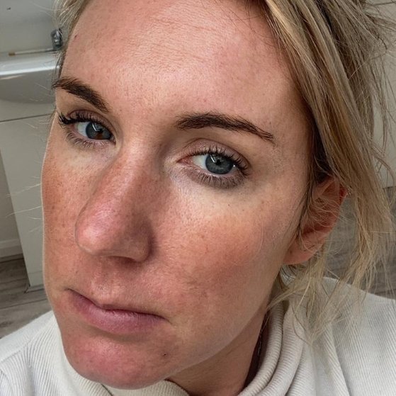 dermal_fillers_farnham_after