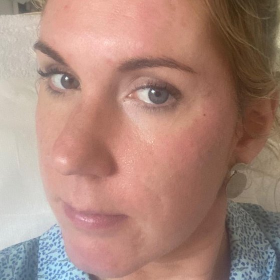 dermal_fillers_farnham_surrey_before