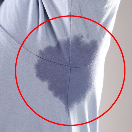 hyperhidrosis before