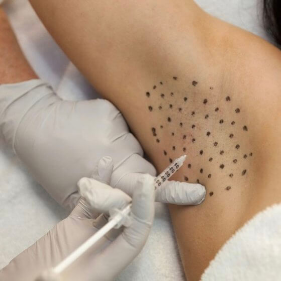 hyperhydrosis treatment