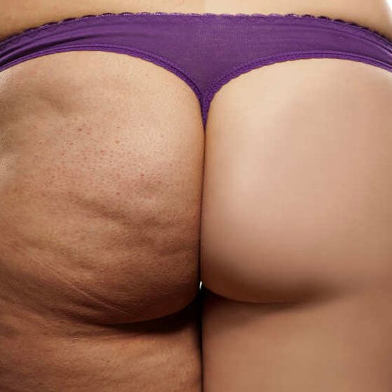 mesotherapy-cellulite-treatment