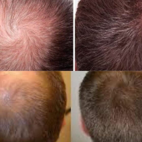 mesotherapy-for-hair-loss-treatment
