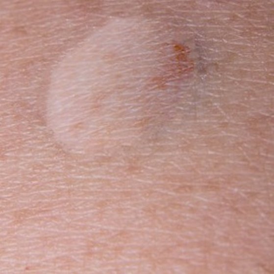 minor surgery after vk5lav9