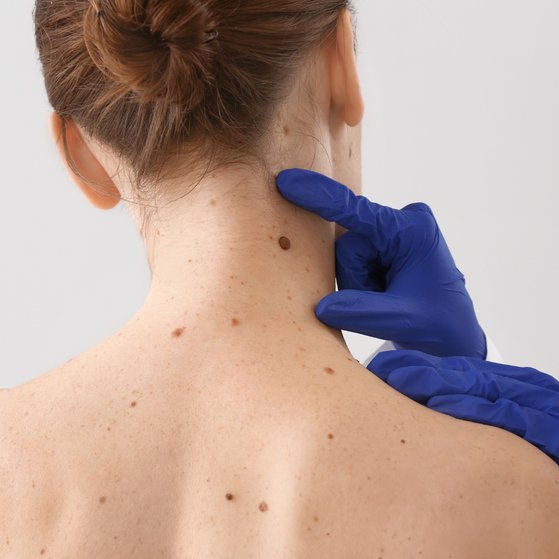 Mole checks, skin cancer screening