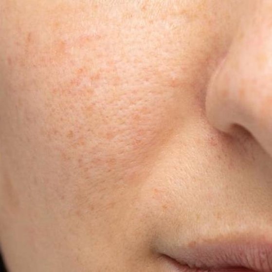 rosacea after