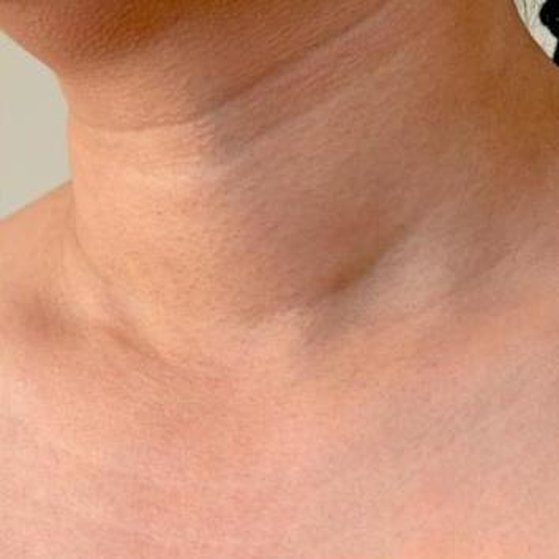 Skin Tag Removal 2 skin tag after