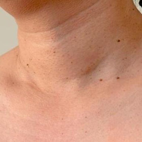 Skin Tag Removal 1 skin tag before