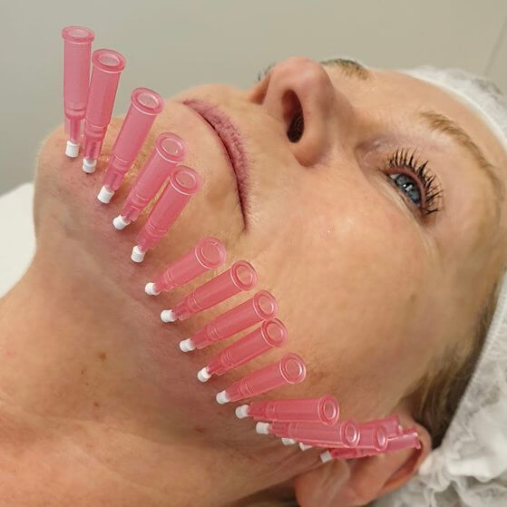 thread lifts treatment