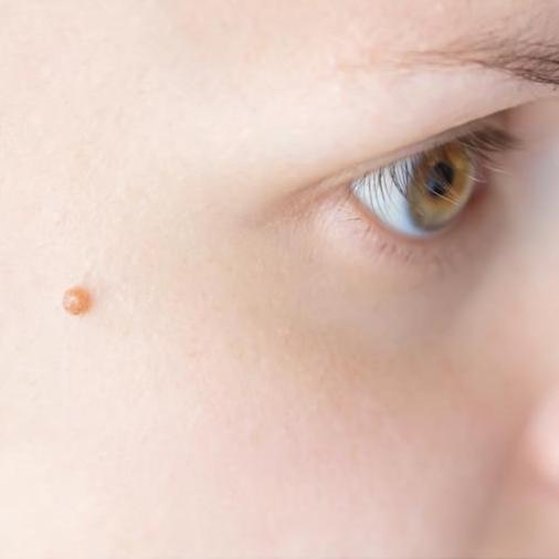 Wart and Verruca Removal 2 wart removal before