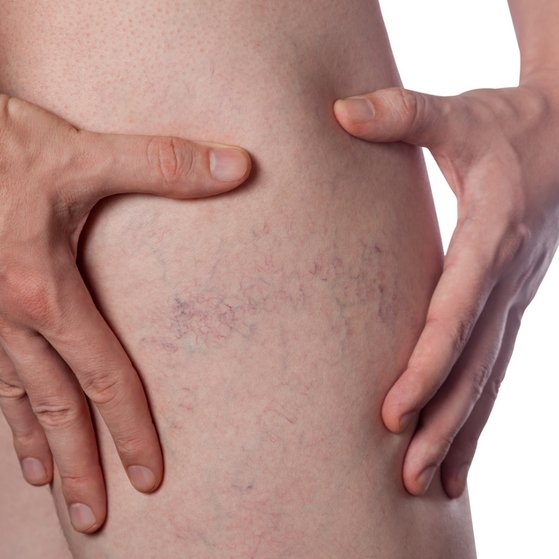 what thread veins look like