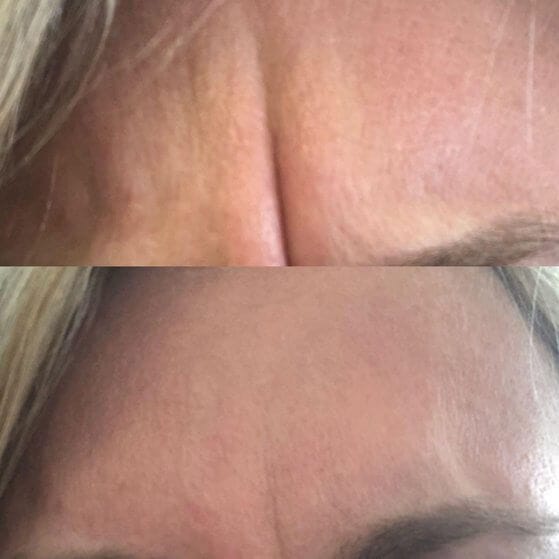 wrinkle relaxers treatment