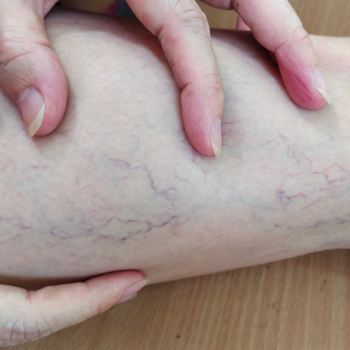 Leg Thread Veins