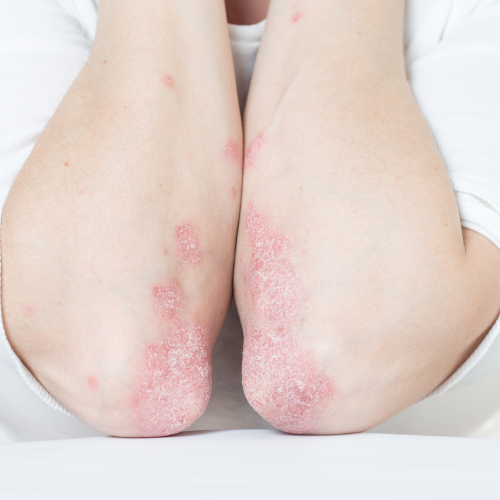 Psoriasis