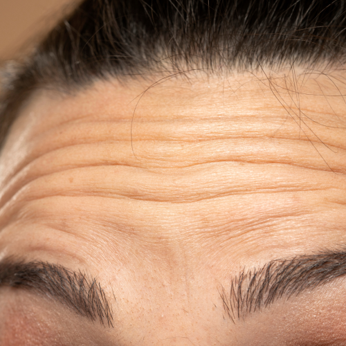 Forehead Lines