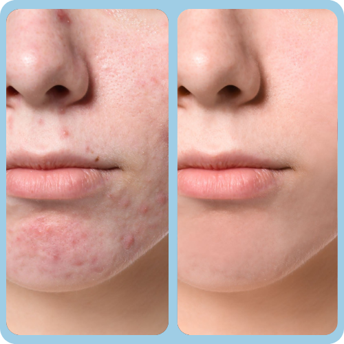 Acne Treatments in Puttenham, Surrey 1 Acne_Before_and_After_1_0502dbc7-bcad-4fbc-882d-c68be41ee48a