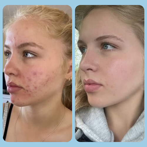 Acne Treatments in Puttenham, Surrey 2 Acne_Before_and_After_2