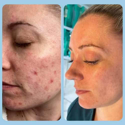 Acne Treatments in Puttenham, Surrey 3 Acne_Before_and_After_3