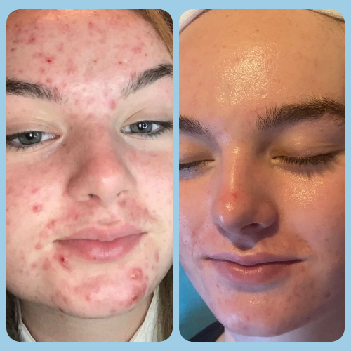 Acne Treatments in Puttenham, Surrey 4 Acne_Before_and_After_4