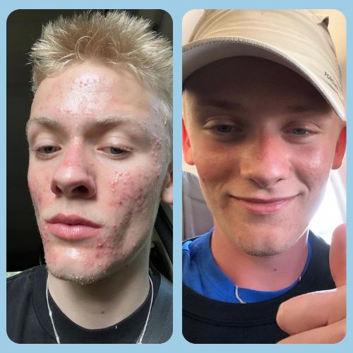 Acne before and after