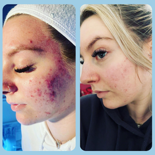 Acne Treatments in Puttenham, Surrey 6 Acne_Before_and_After_6_3947a29b-bce0-4ce1-9984-1d3044740ba5