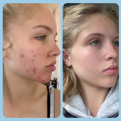 Acne Treatments in Puttenham, Surrey 7 Acne_Before_and_After_7