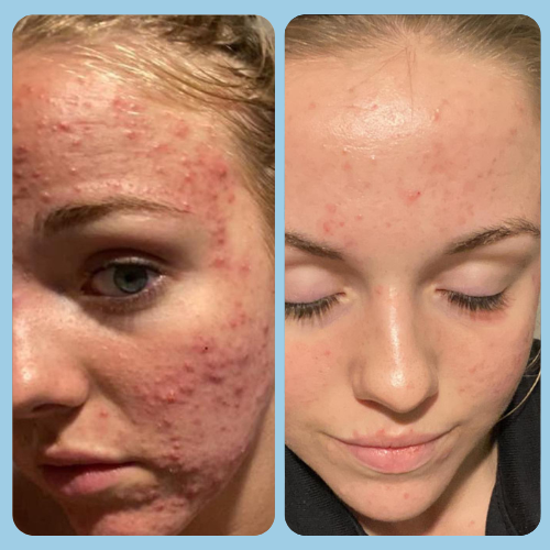 Acne Before and After