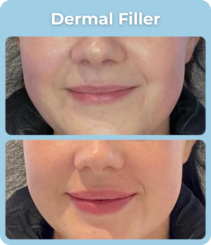 Dermal_Filler_Before_and_After_-_The_Skin_Investment_Clinic_Farnham_Surrey_-_Aesthetics_and_Injectables_2