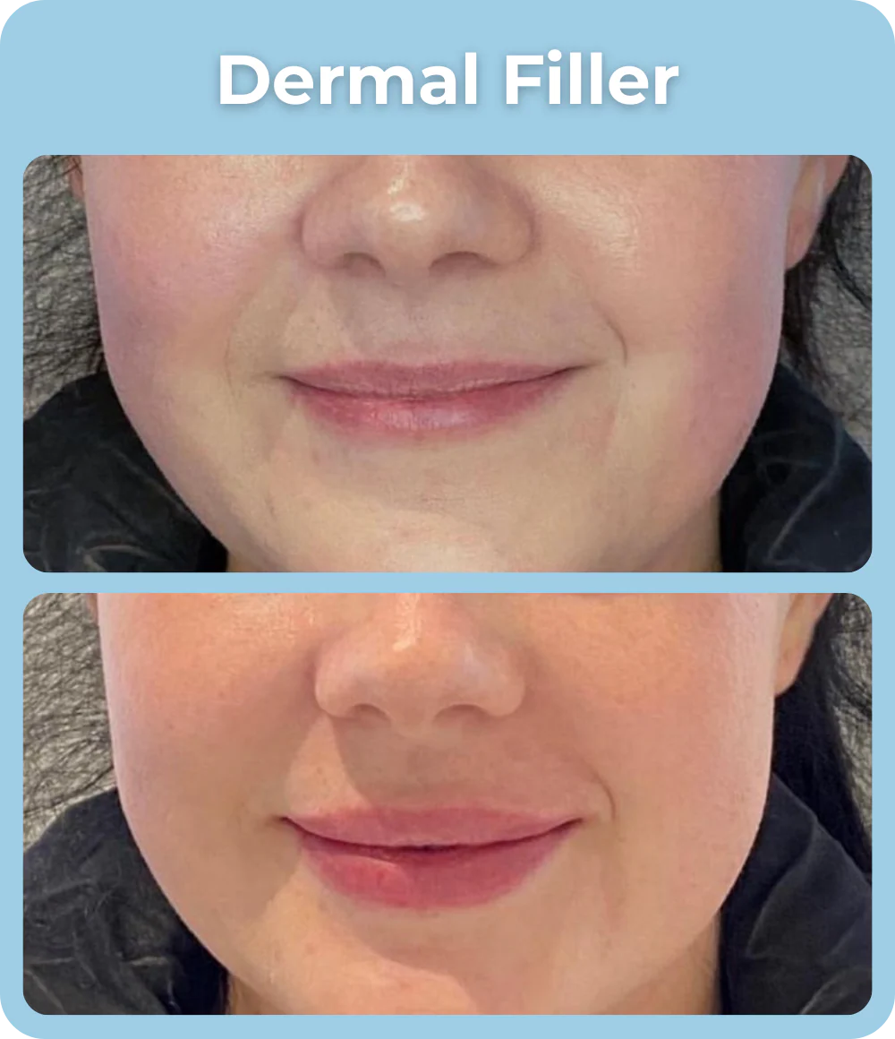 Dermal_Filler_Before_and_After_-_The_Skin_Investment_Clinic_Farnham_Surrey_-_Aesthetics_and_Injectables_2